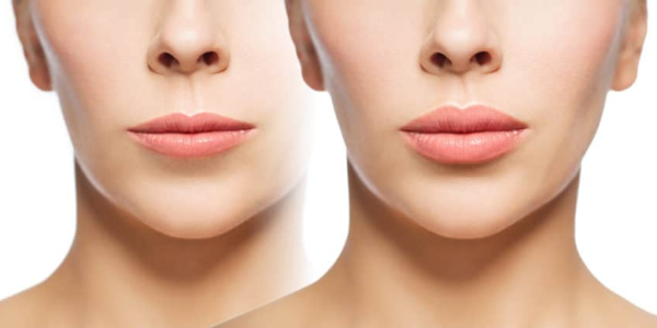 Understanding Sculpt Fat Transfer: A Comprehensive Guide