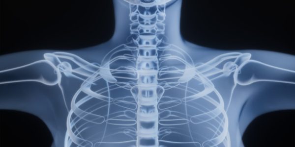 X-ray image of a human spine and ribcage